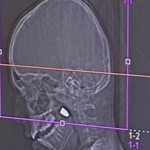 קליע נשלף בניתוח מראשו של ילד בן ה-11 שנפגע מכדור תועה בחגיגות ערב השנה האזרחית