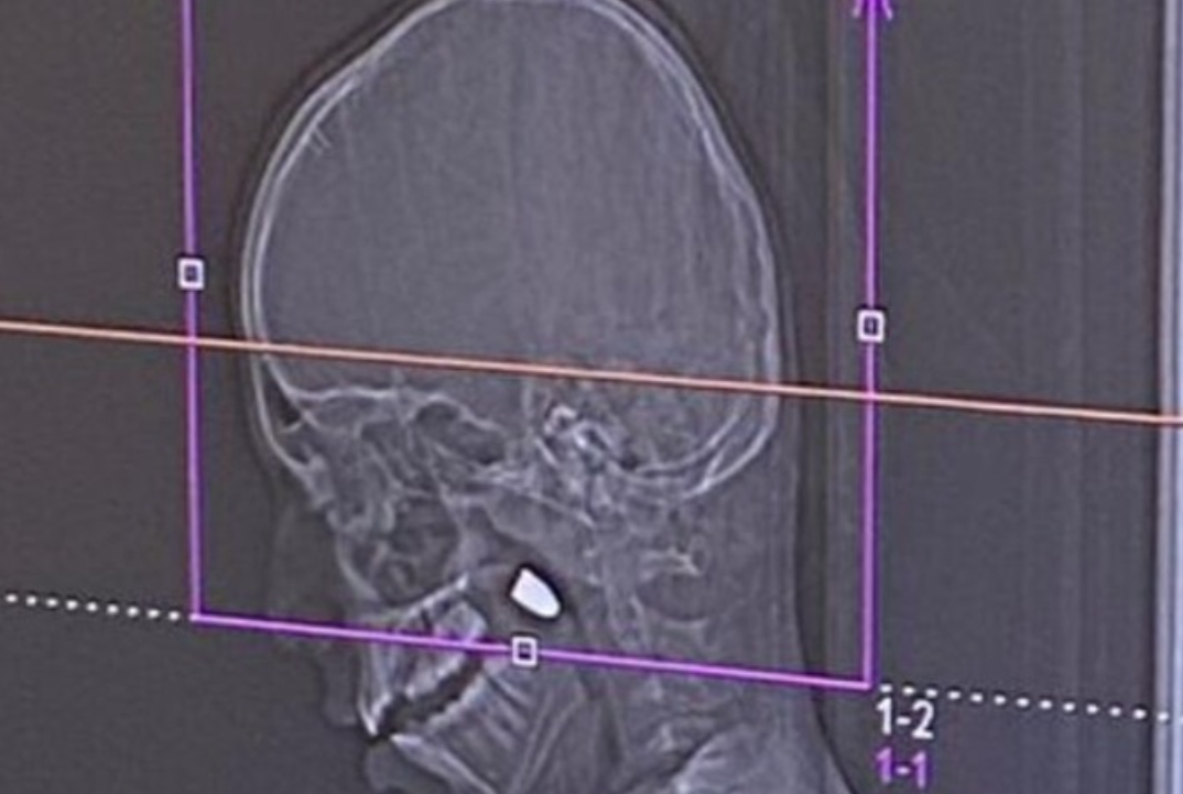 מצורף: הדמיית הקליע שננעץ בראשו של הילד,